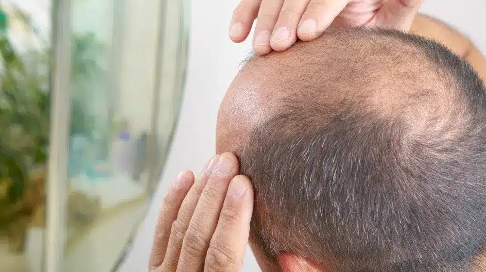 Hair loss stem cell therapy