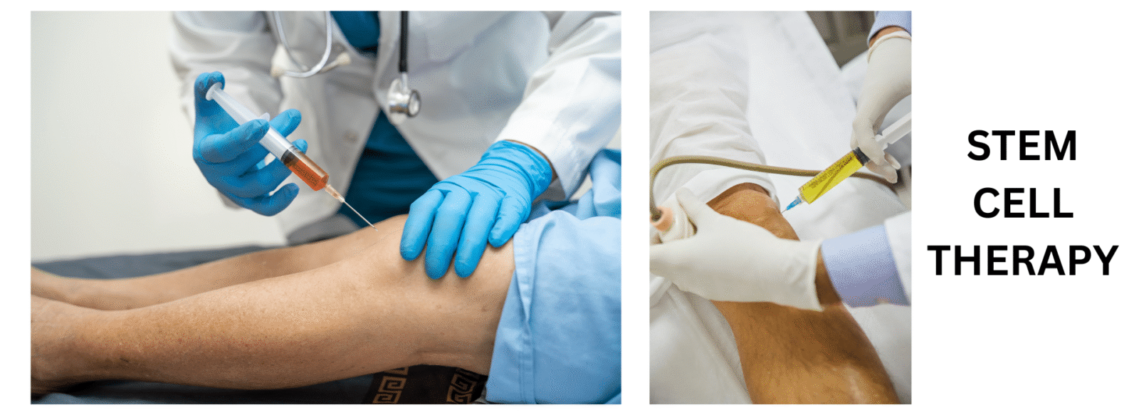 Neurocyte – The Best Place to Get Stem Cell Treatment in